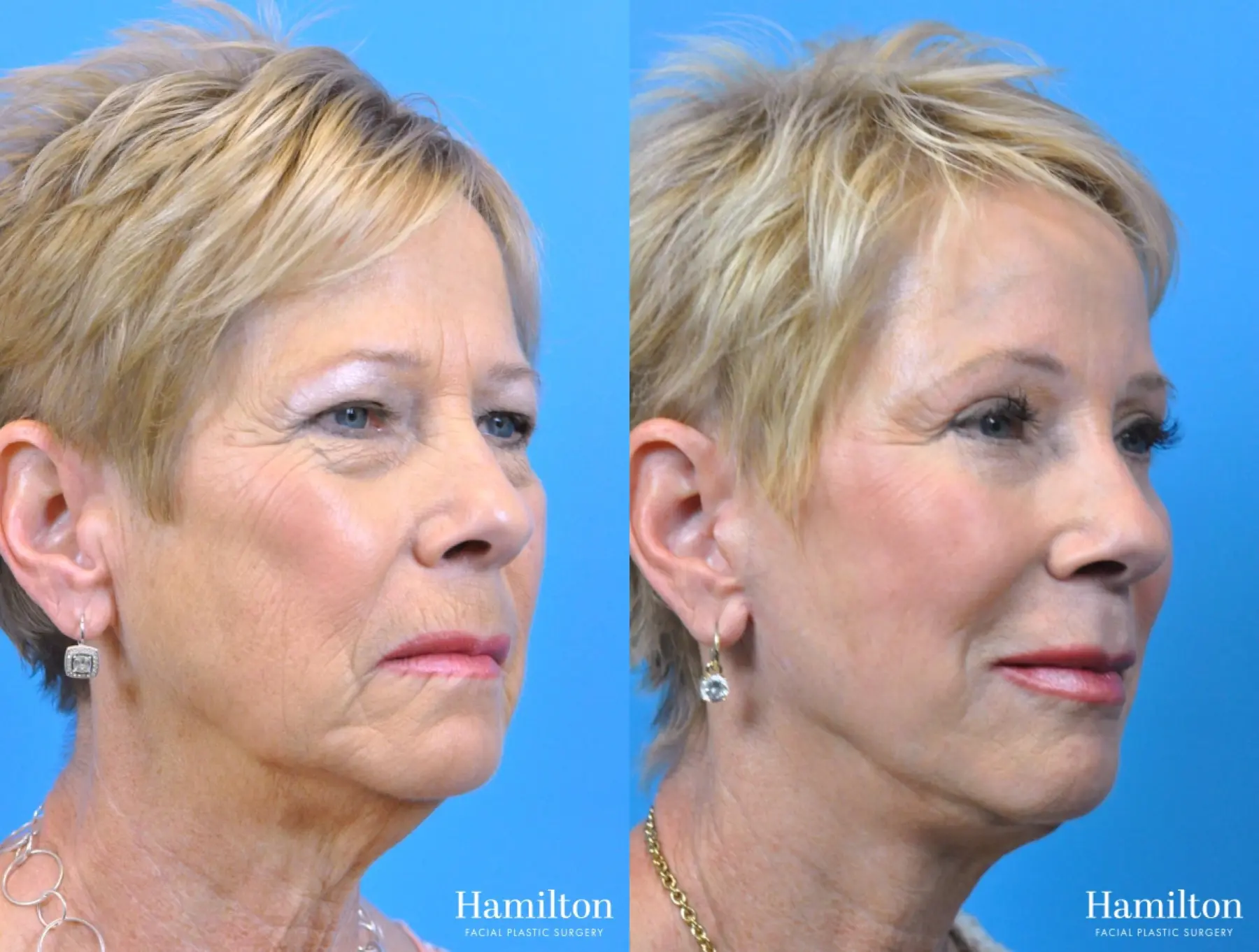 Facelift: Patient 5 - Before and After 3