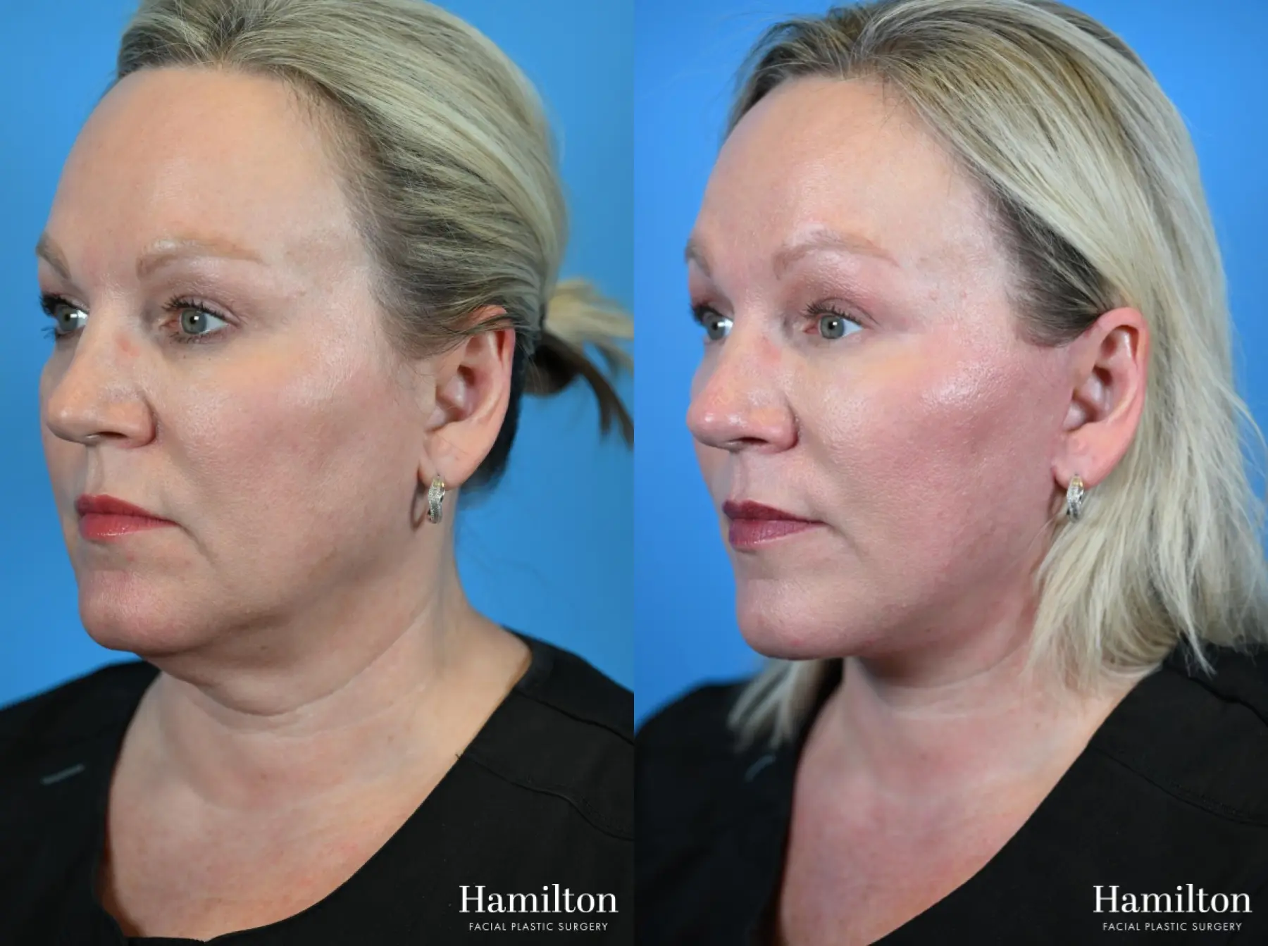 Facelift: Patient 29 - Before and After 3