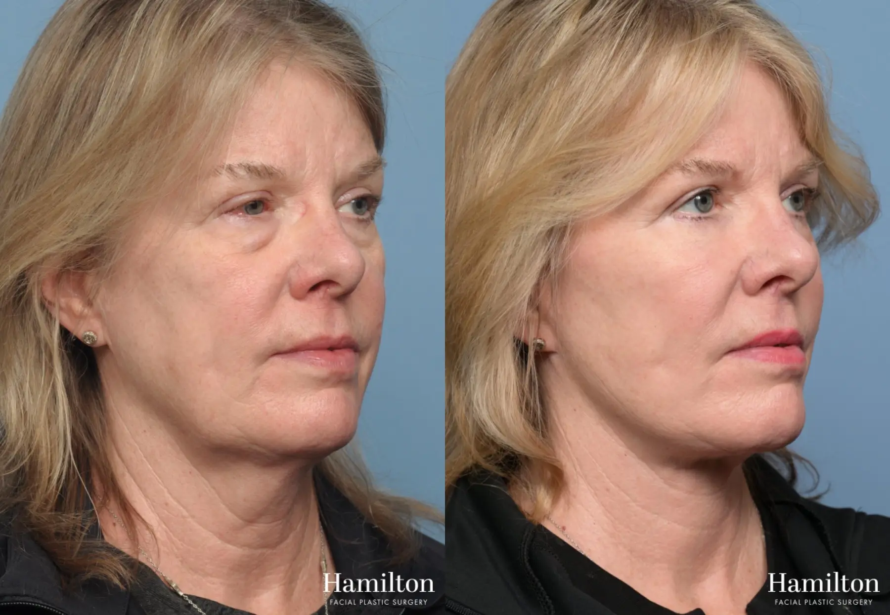 Facelift: Patient 40 - Before and After 1