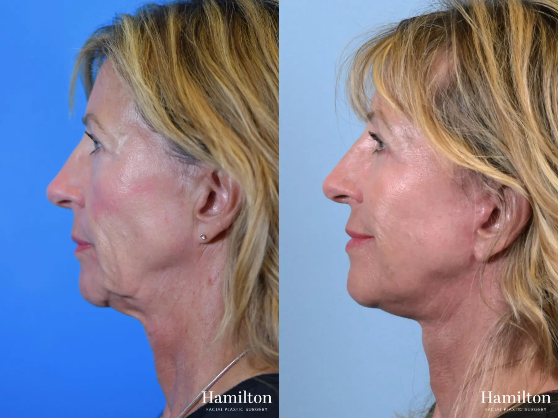 Facelift: Patient 17 - Before and After 4