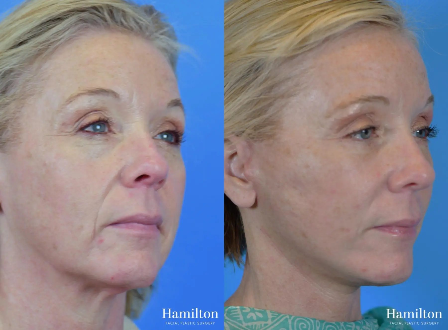 Facelift: Patient 30 - Before and After 4