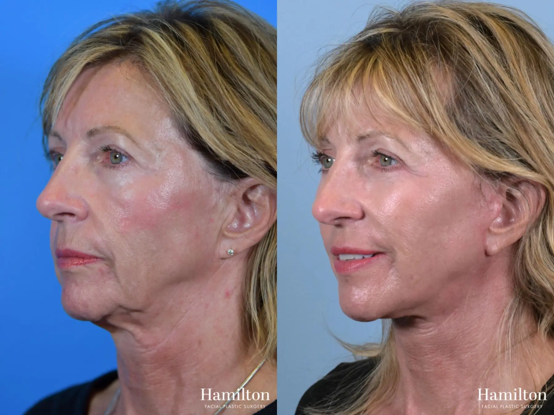 Facelift: Patient 17 - Before and After 1