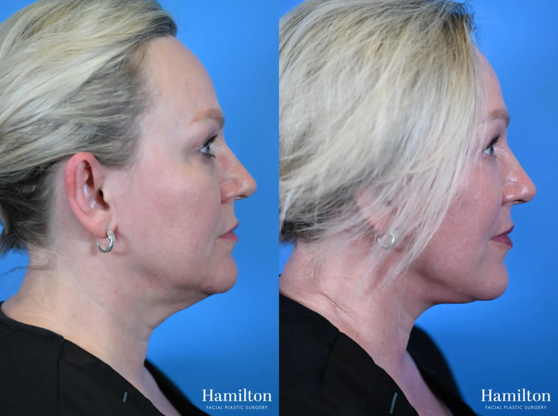 Facelift: Patient 29 - Before and After 4