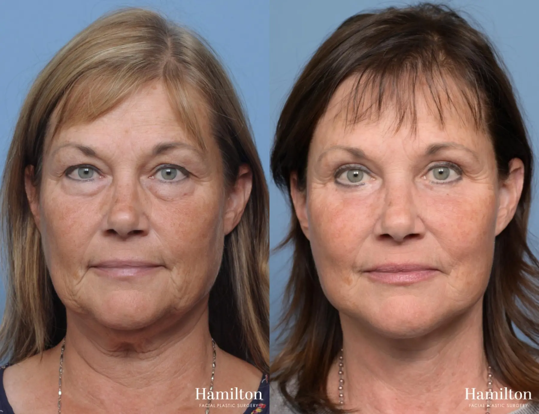 Facelift: Patient 3 - Before and After 5