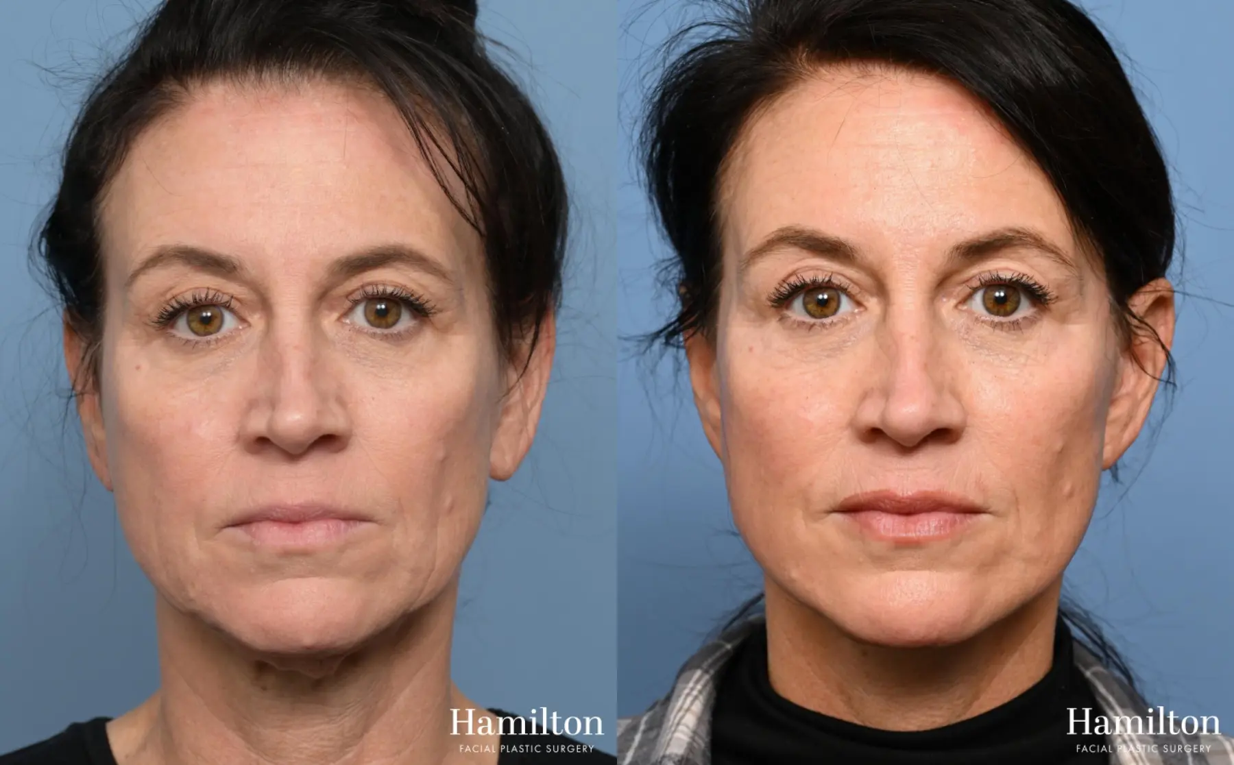 Facelift: Patient 25 - Before and After 4