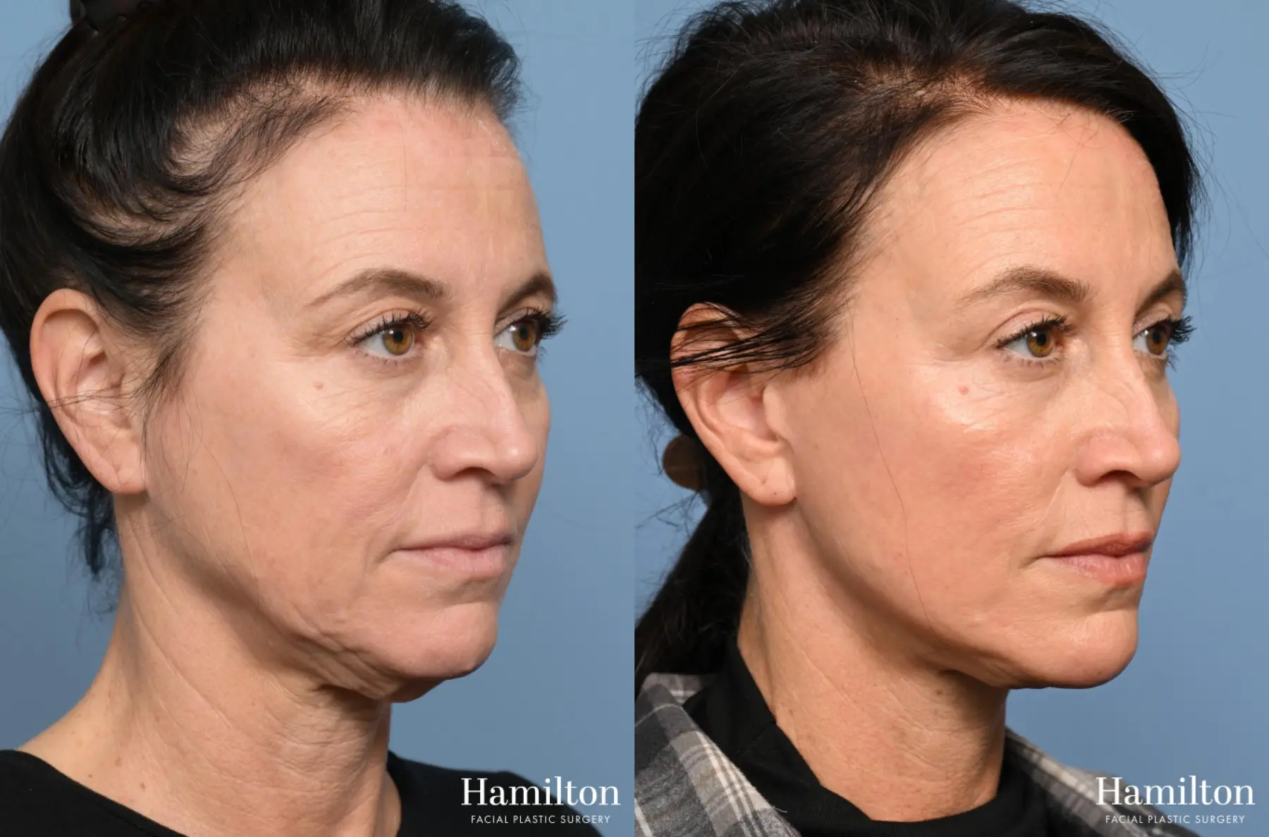 Facelift: Patient 25 - Before and After 3