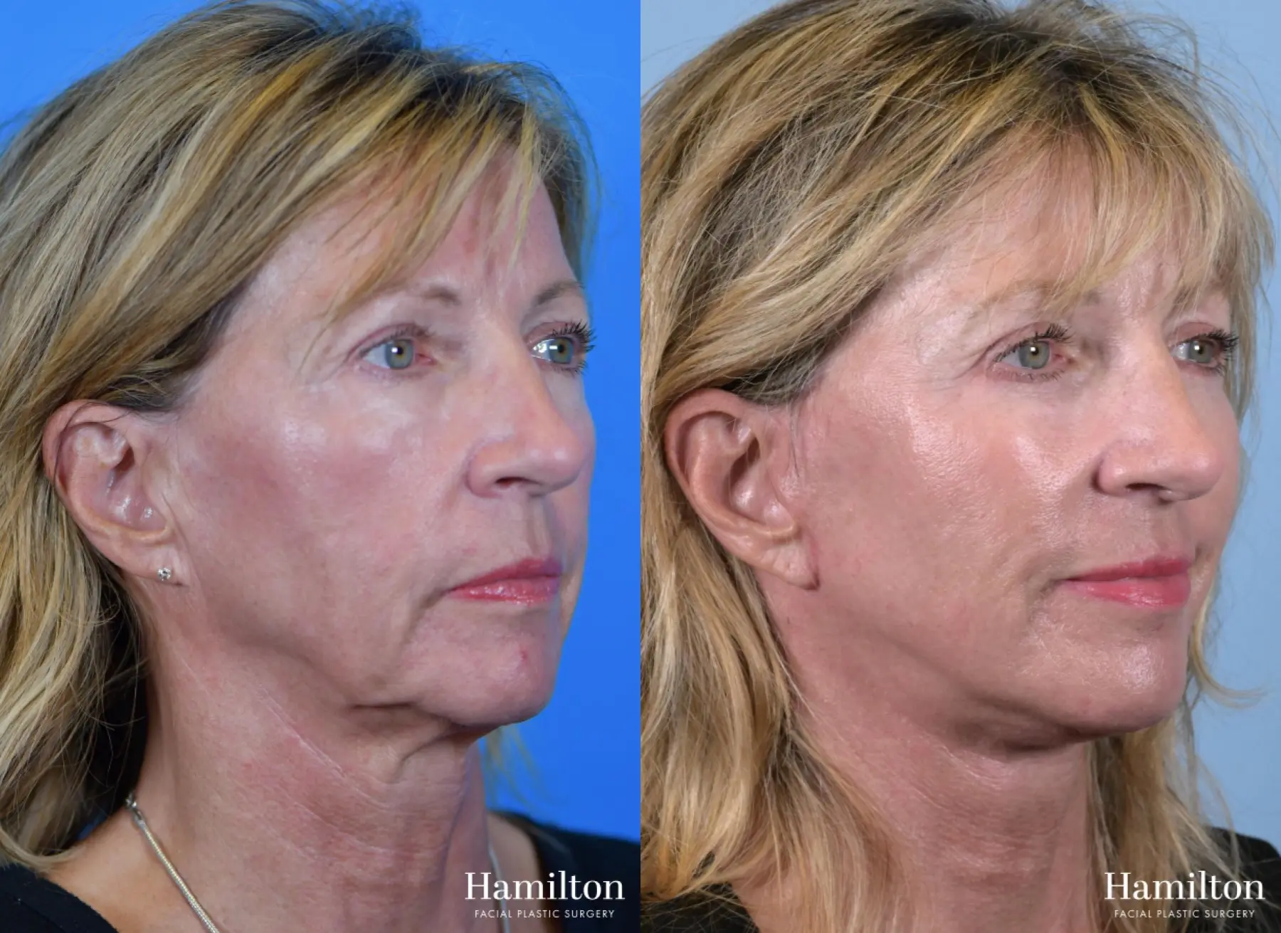 Facelift: Patient 17 - Before and After 3