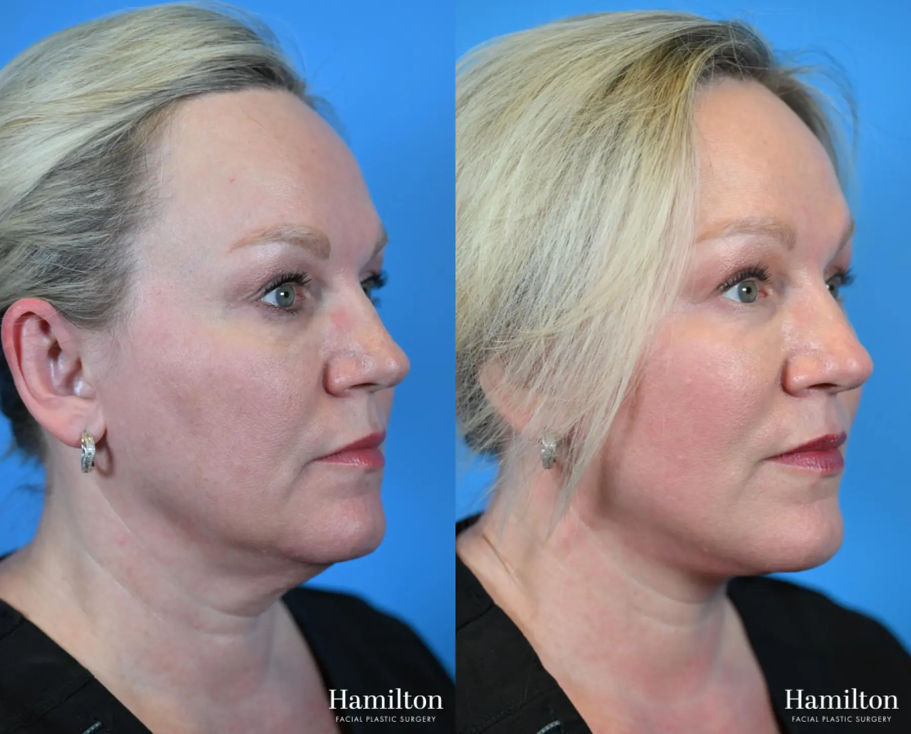 Facelift: Patient 29 - Before and After 2