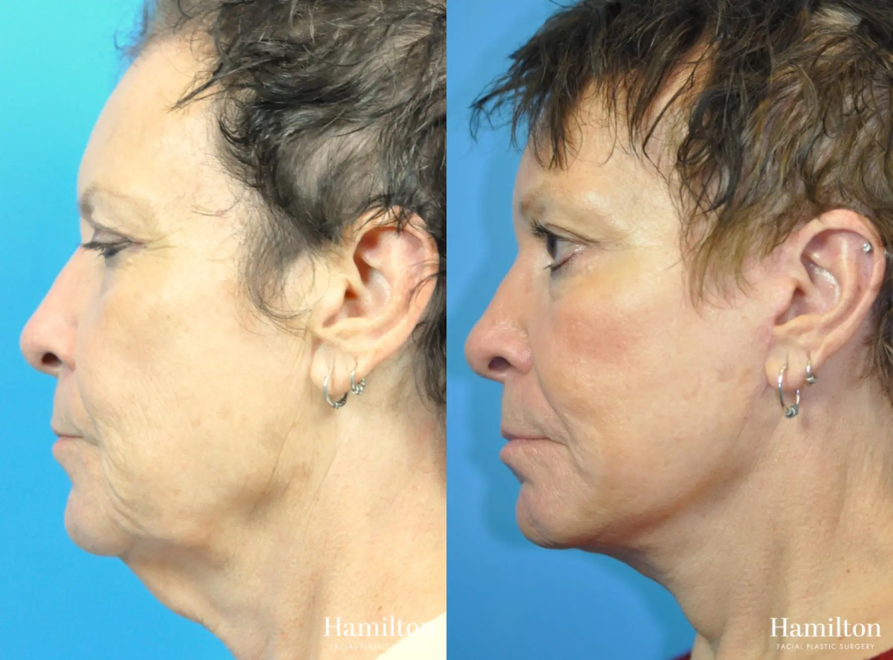 Facelift: Patient 39 - Before and After 1