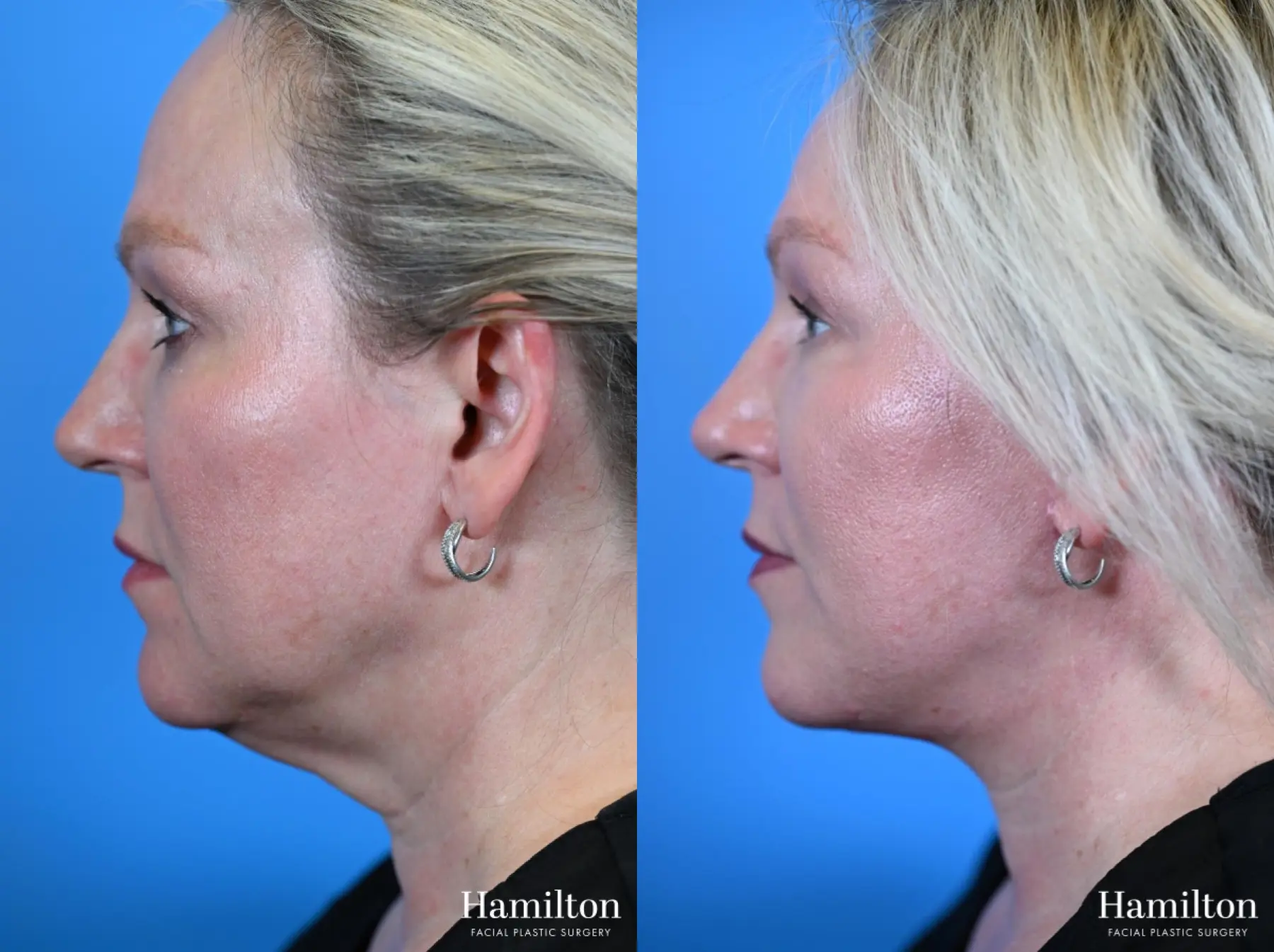 Facelift: Patient 29 - Before and After 1