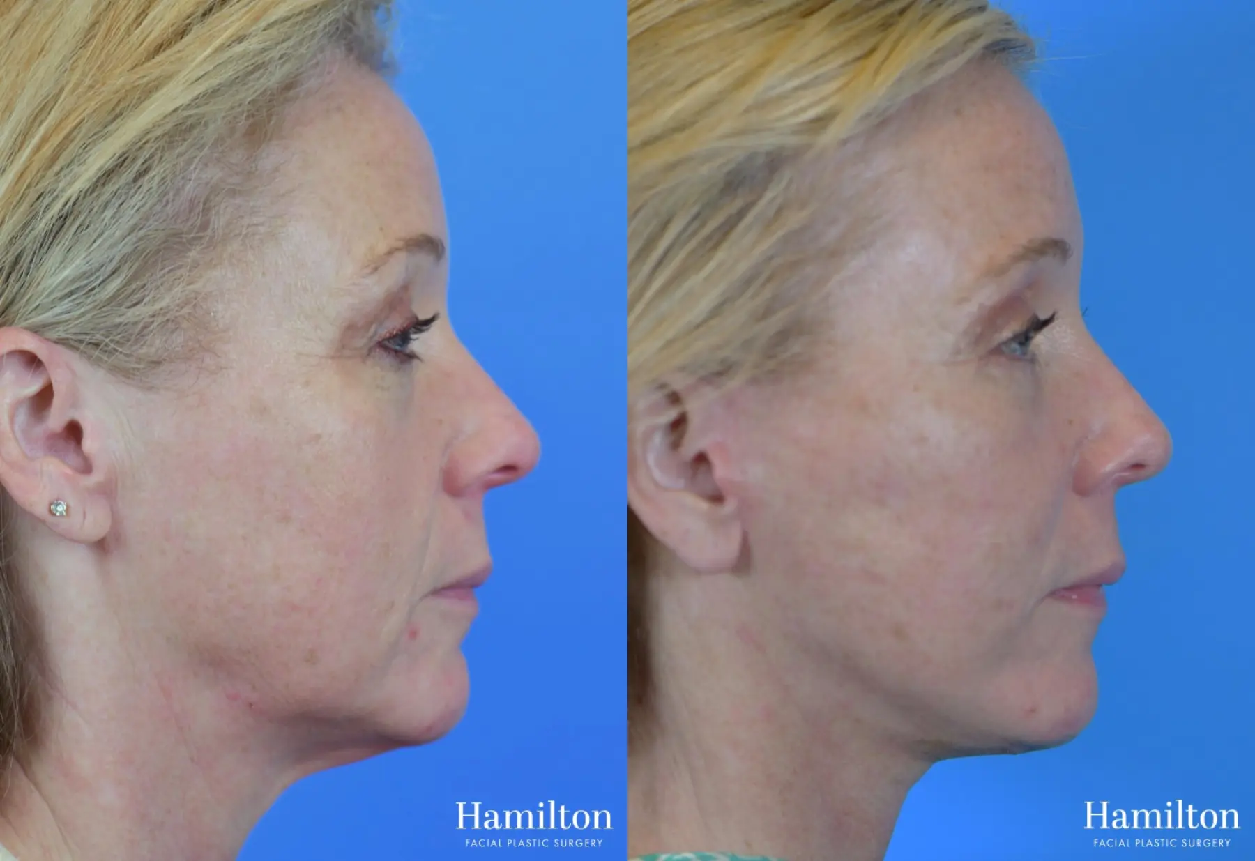 Facelift: Patient 30 - Before and After 2