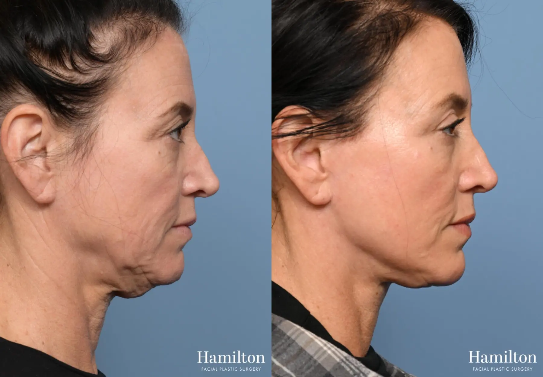 Facelift: Patient 25 - Before and After 2