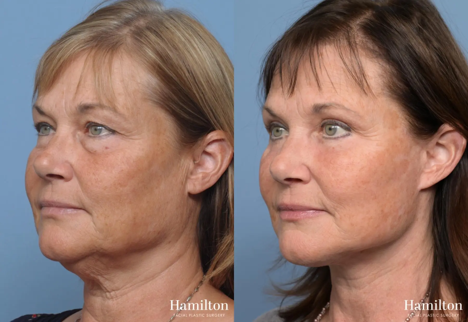 Facelift: Patient 3 - Before and After 2