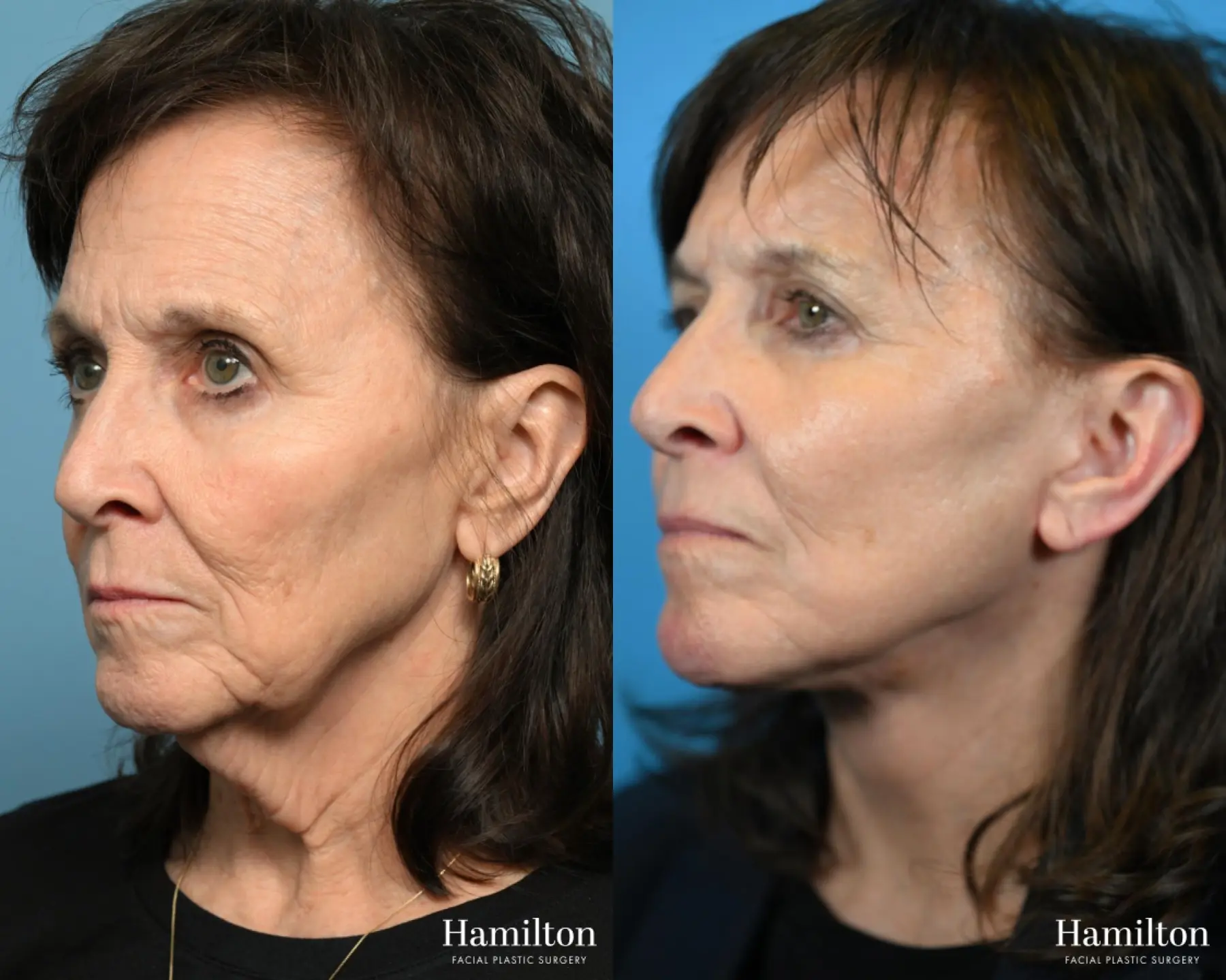 Facelift: Patient 38 - Before and After 2