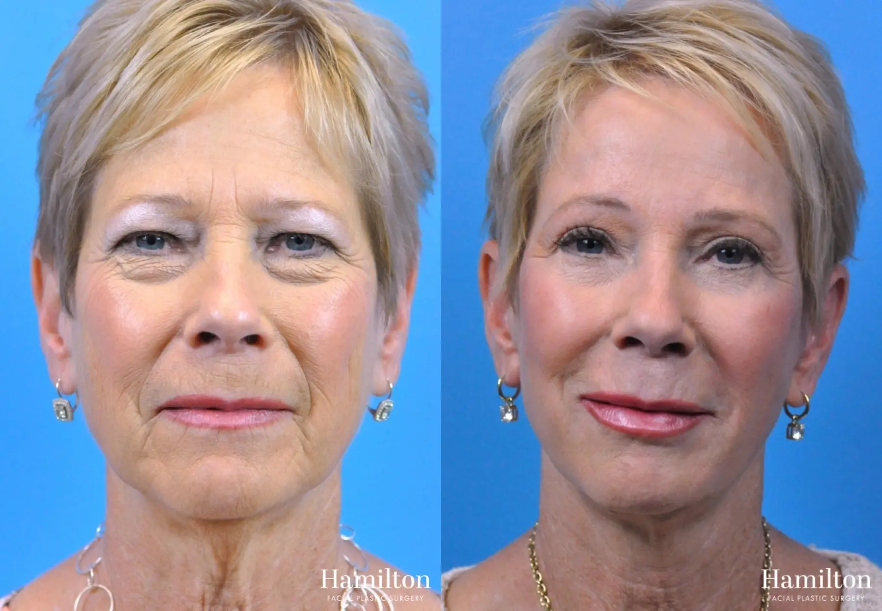 Facelift: Patient 5 - Before and After  