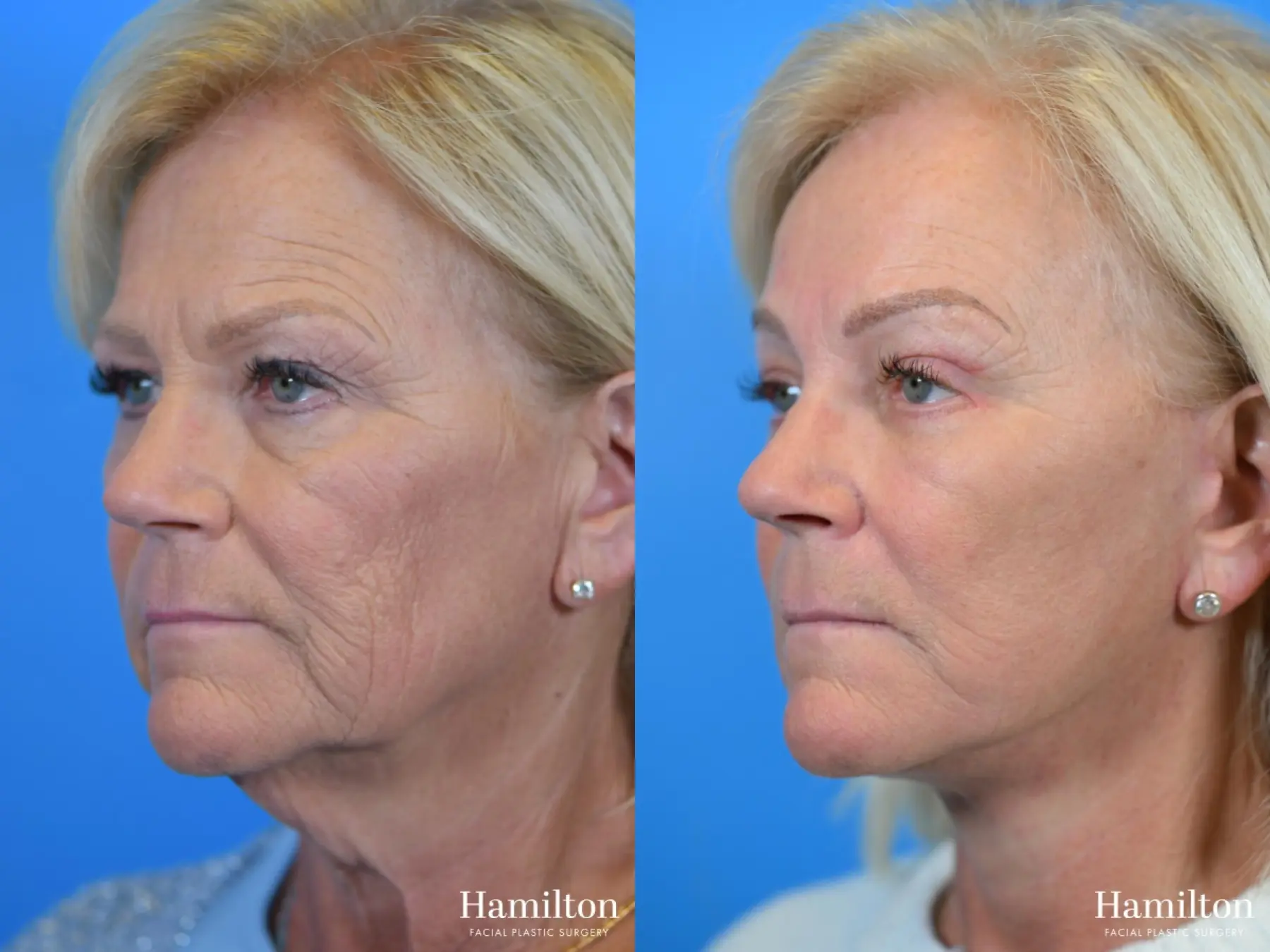 Facelift: Patient 8 - Before and After  