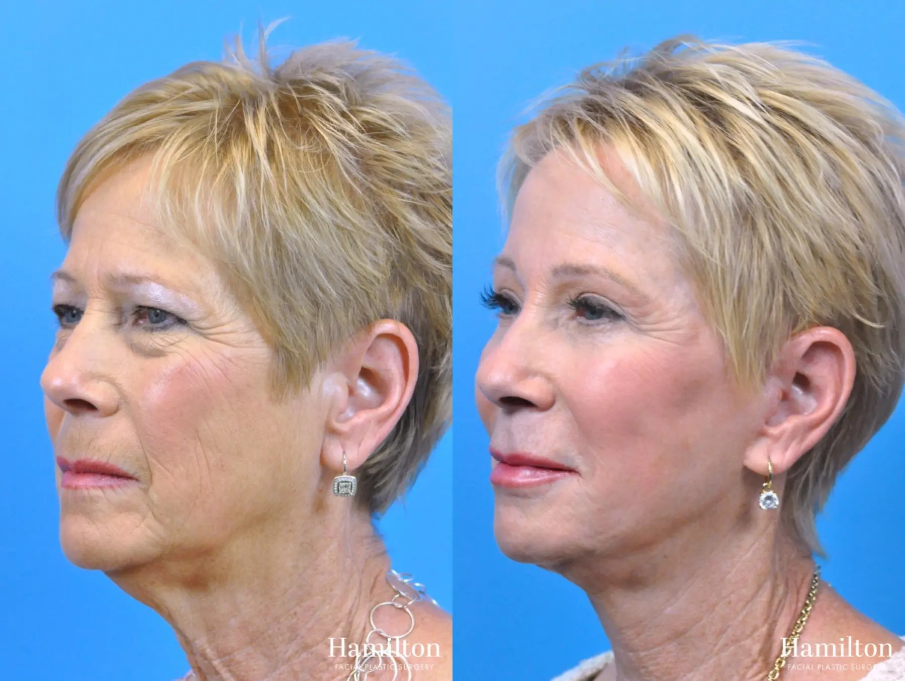 Facelift: Patient 5 - Before and After 2