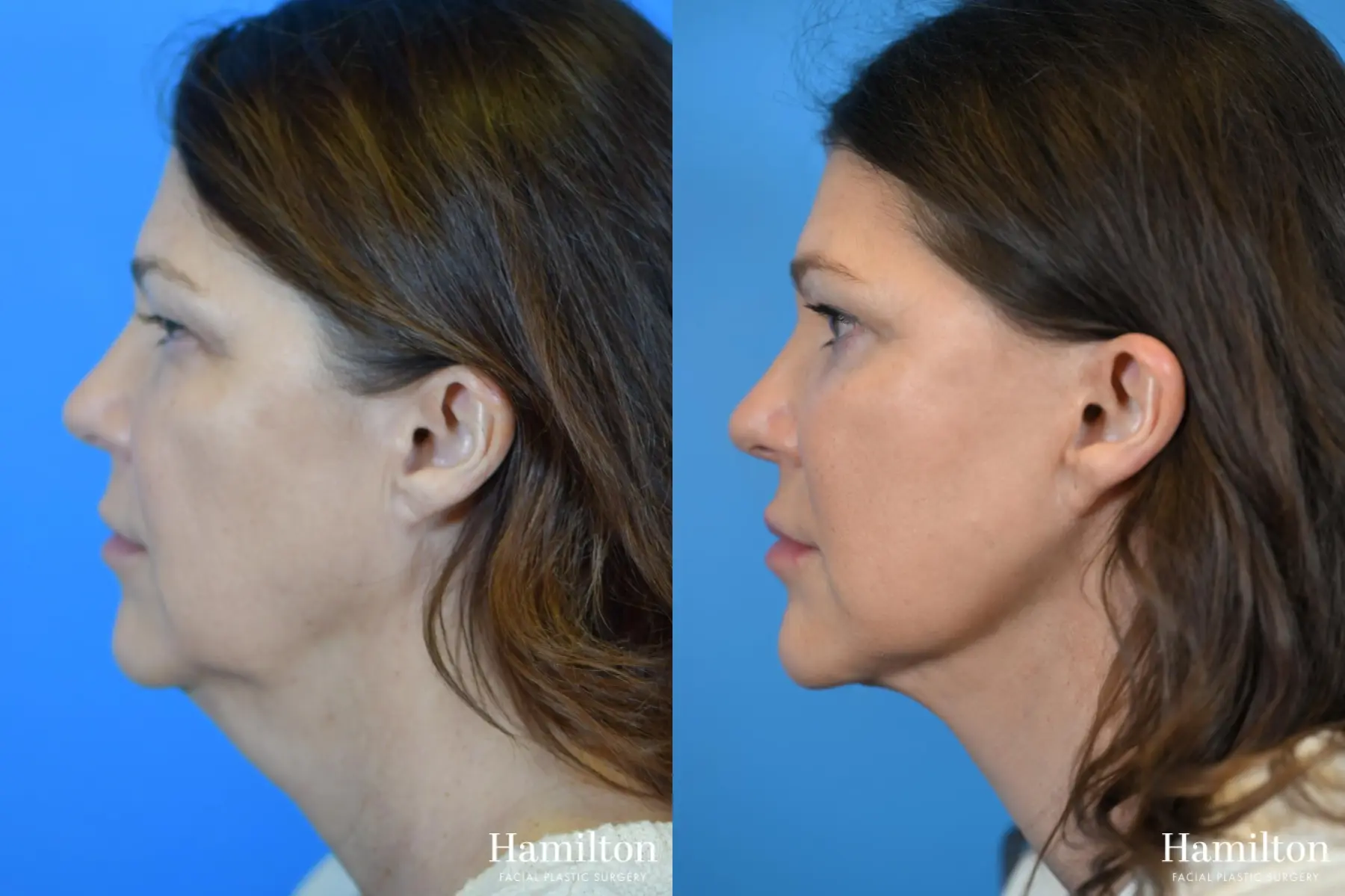 Facelift: Patient 10 - Before and After 4