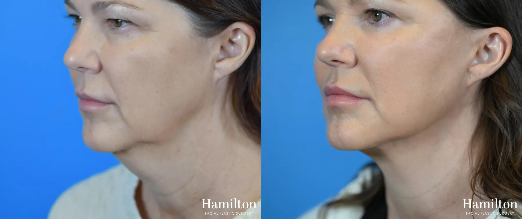 Facelift: Patient 10 - Before and After 3