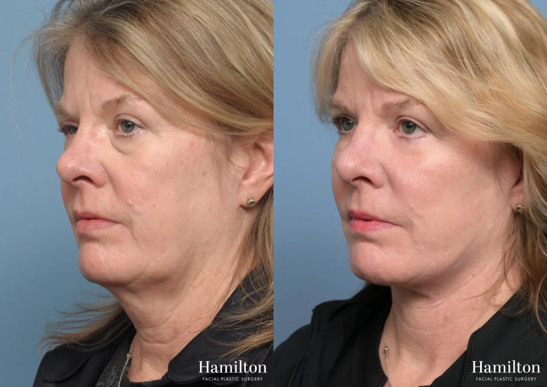 Facelift: Patient 40 - Before and After 3