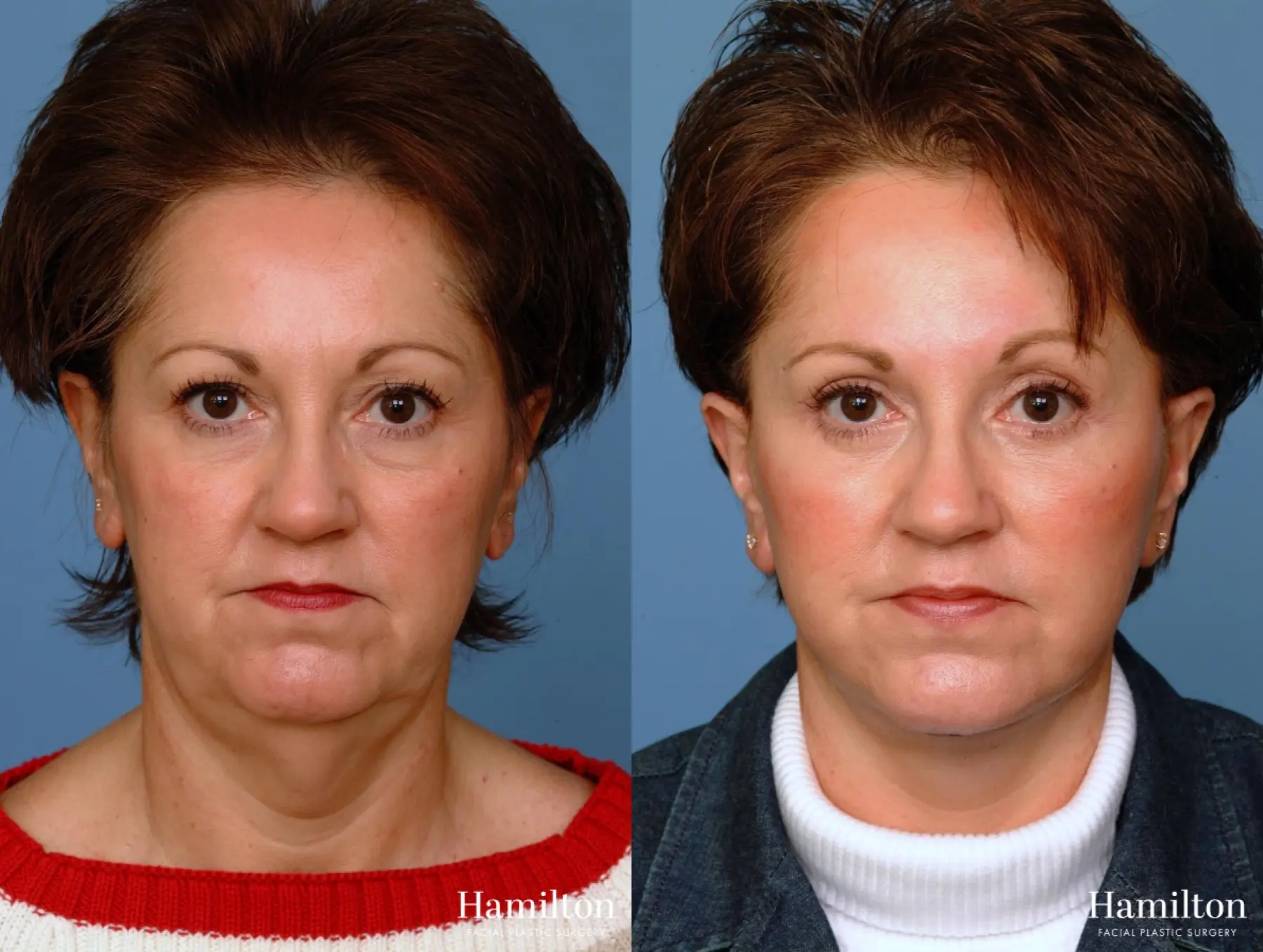 Facelift: Patient 18 - Before and After 3