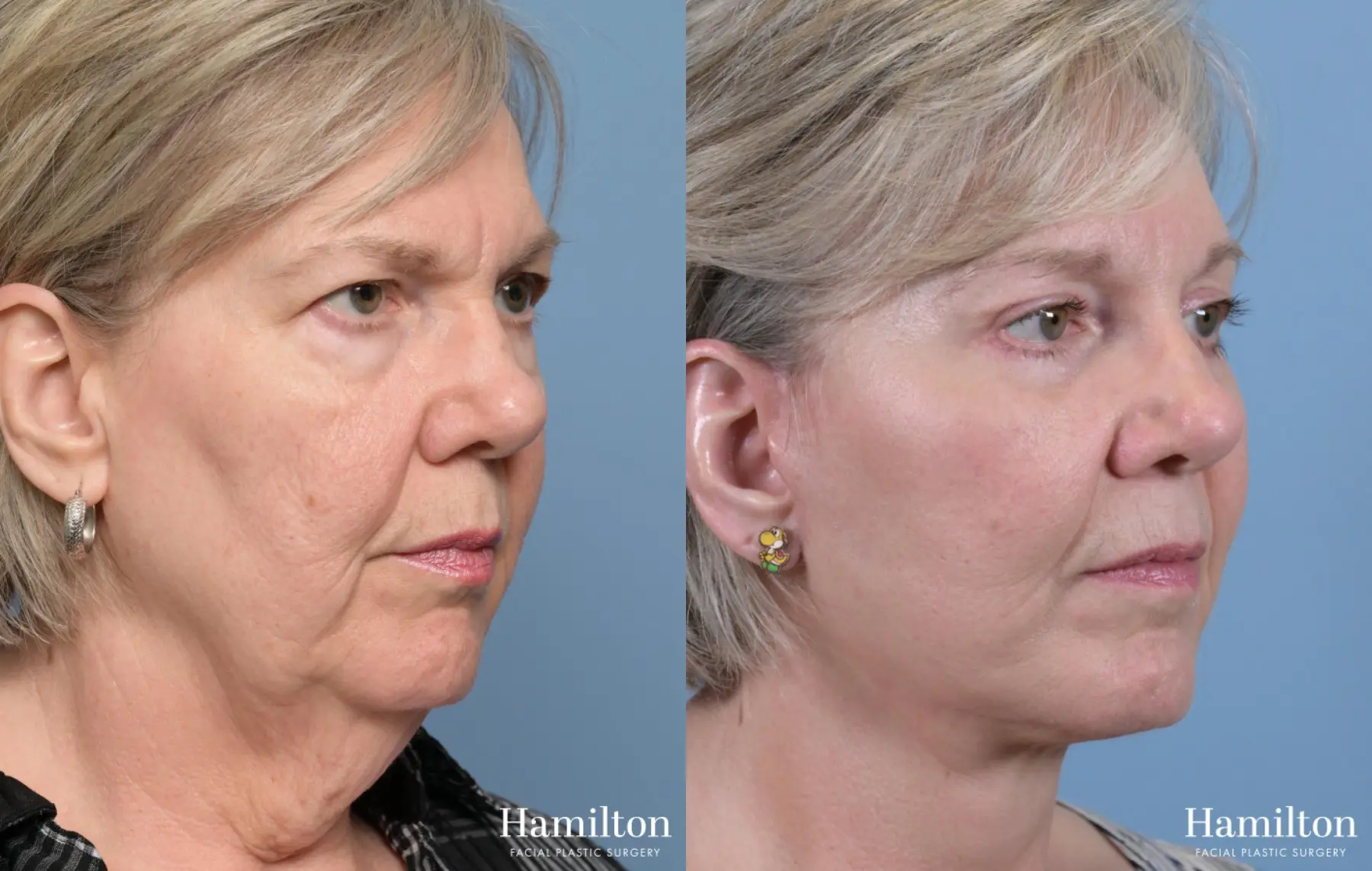 Facelift: Patient 1 - Before and After 3