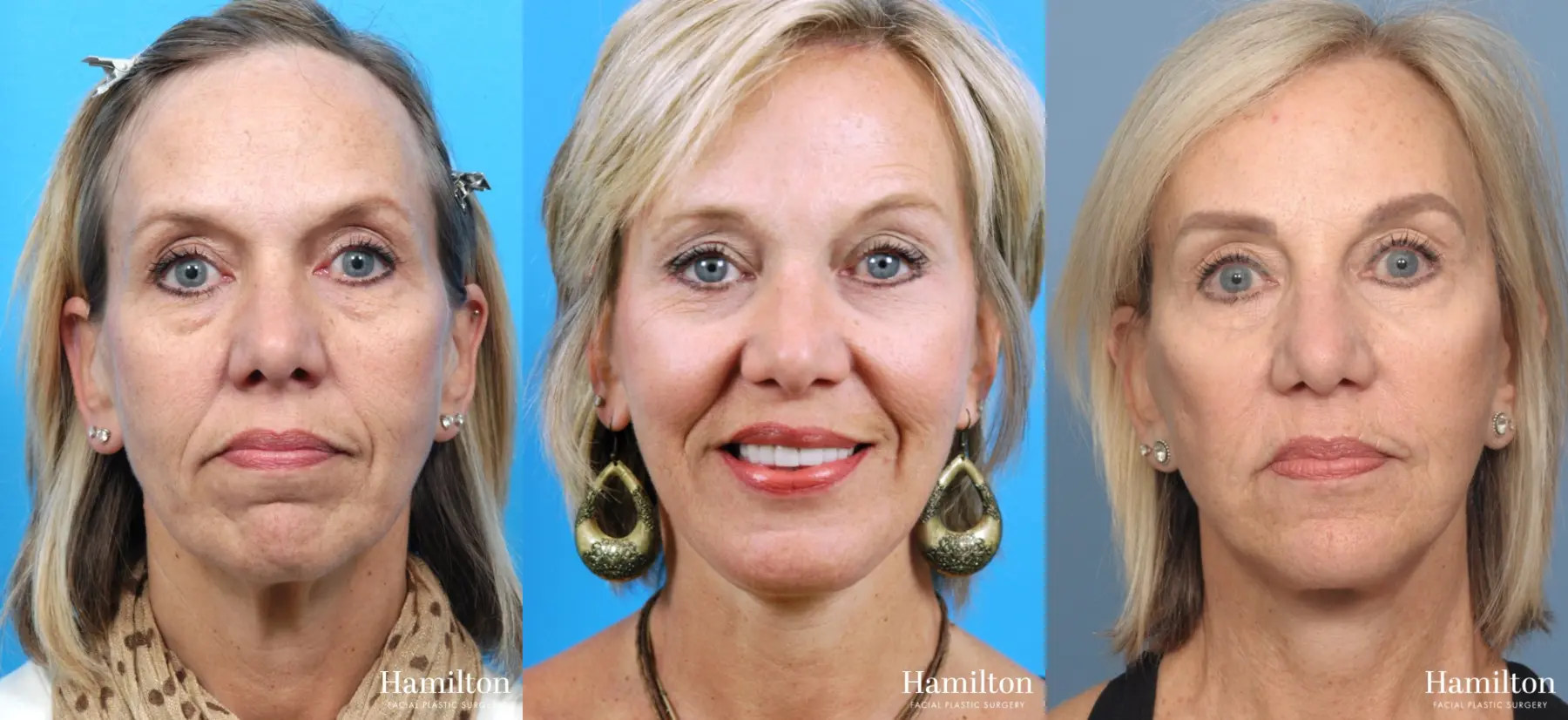 Facelift: Patient 23 - Before and After 1