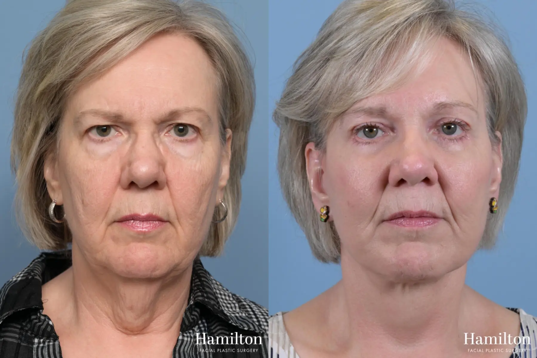 Facelift: Patient 1 - Before and After 5