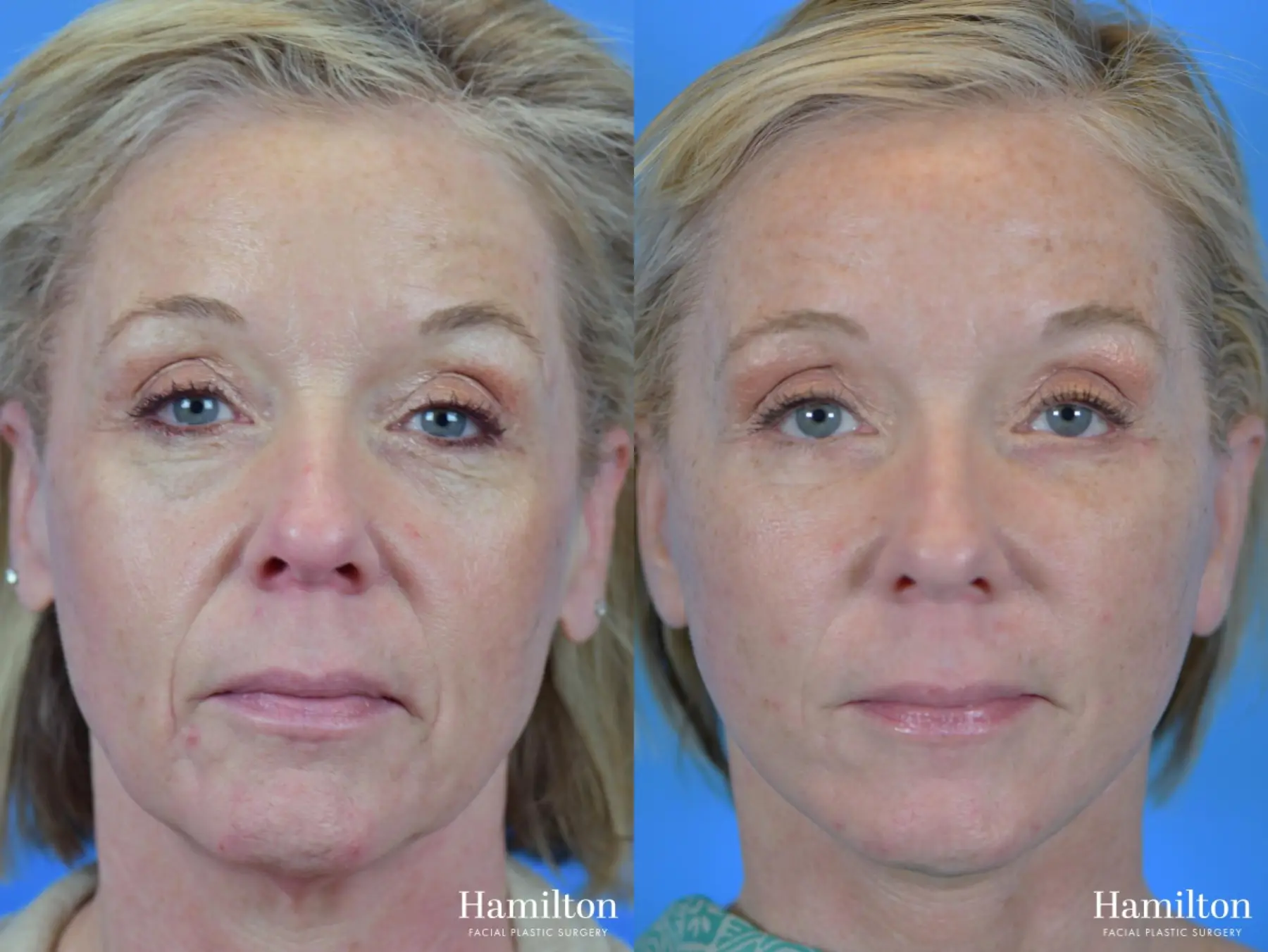 Facelift: Patient 30 - Before and After 1