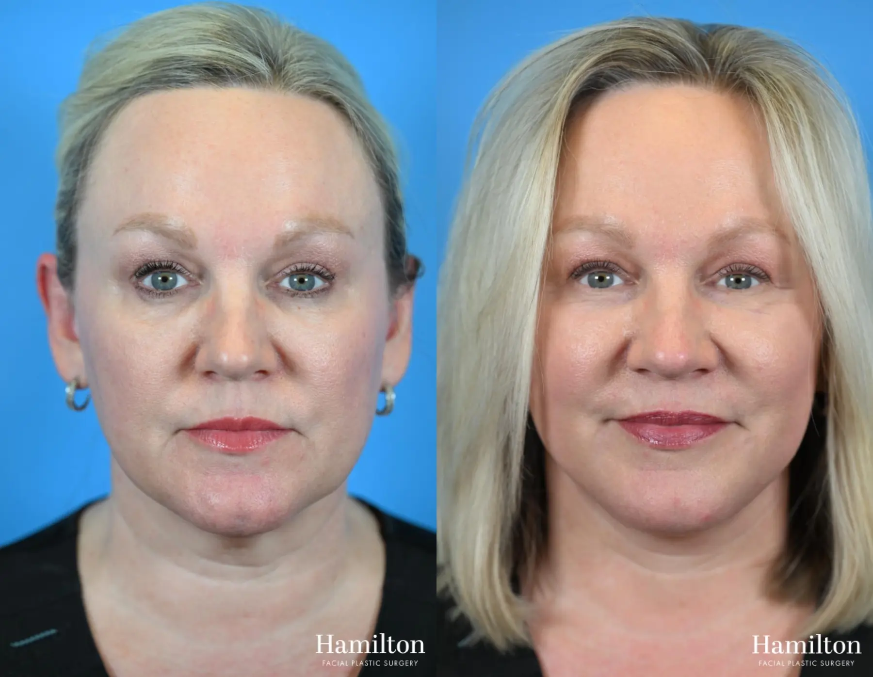 Facelift: Patient 29 - Before and After 5