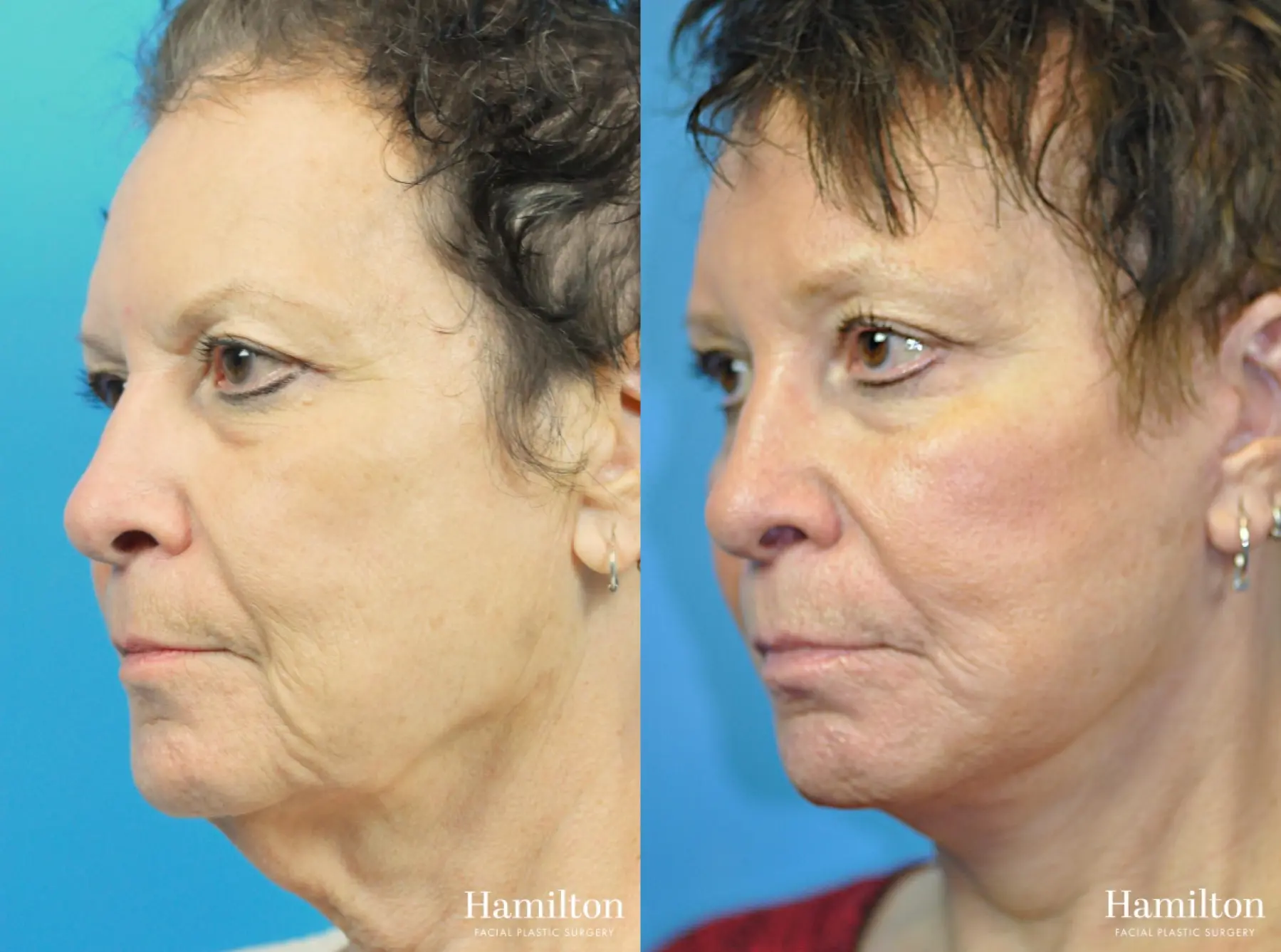 Facelift: Patient 39 - Before and After 5