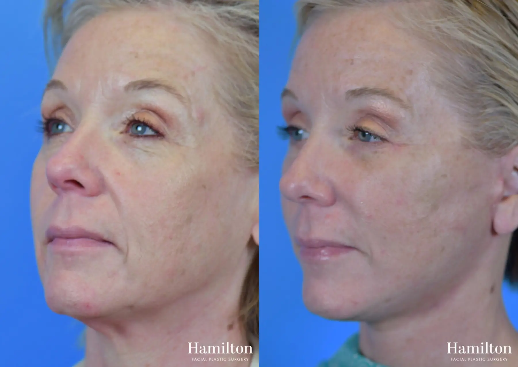 Facelift: Patient 30 - Before and After 3