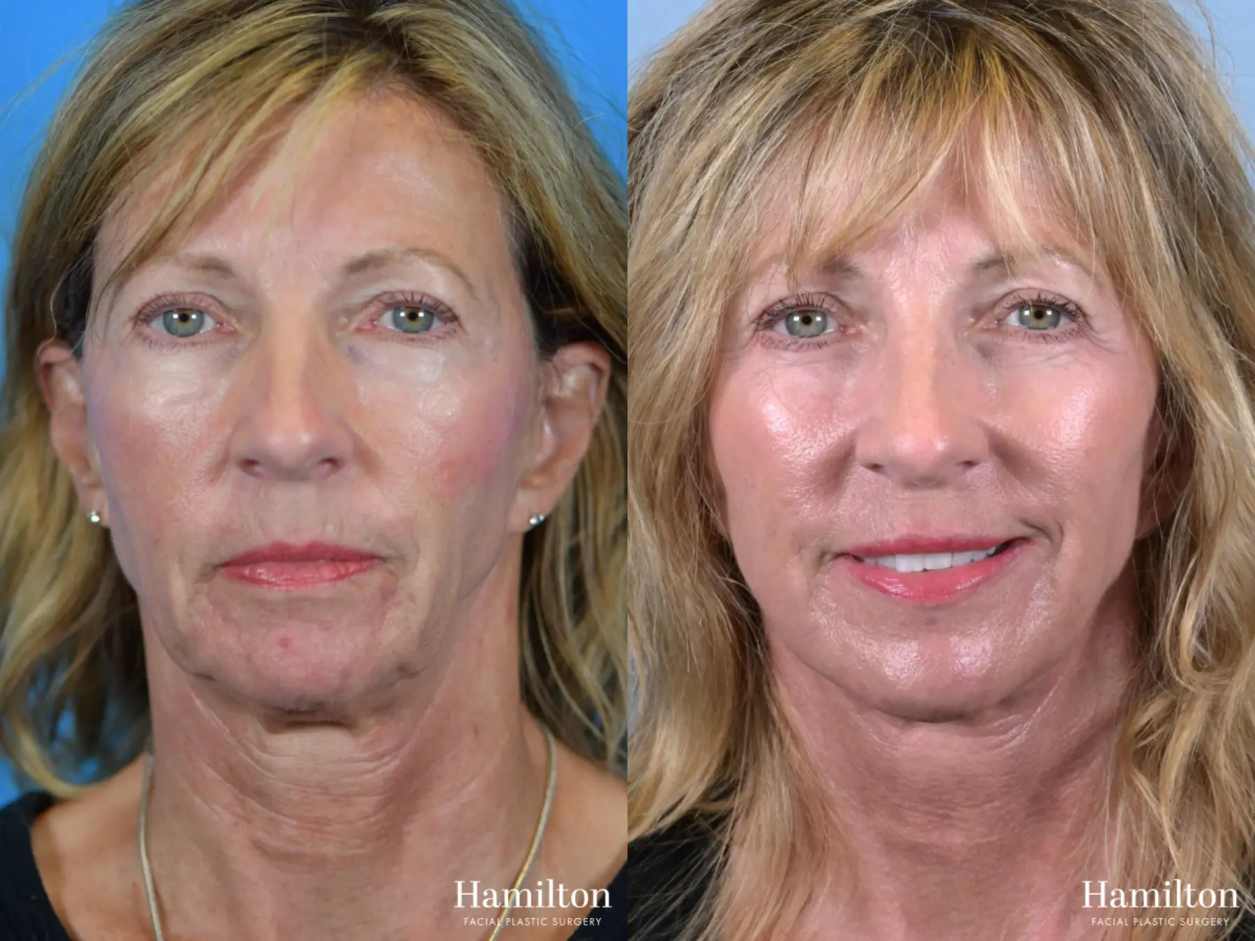 Facelift: Patient 17 - Before and After 5