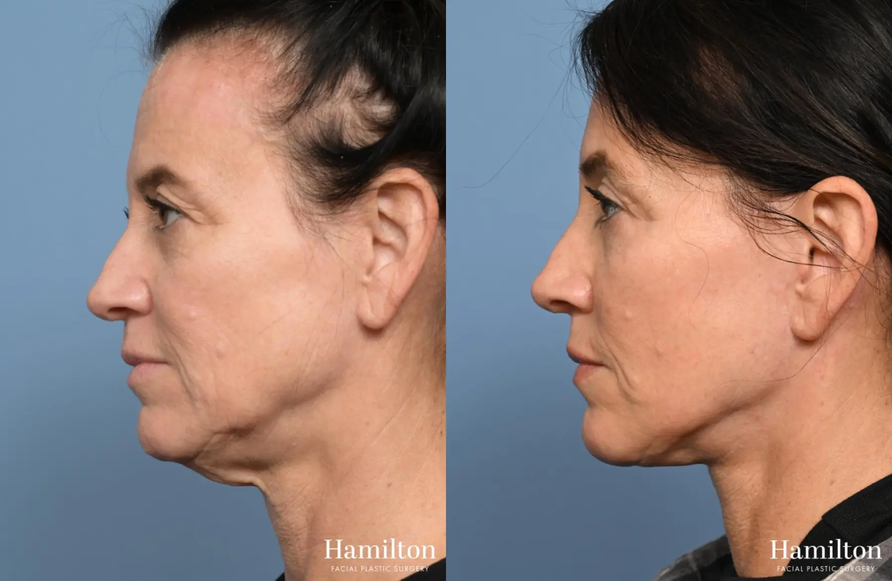 Facelift: Patient 25 - Before and After 5