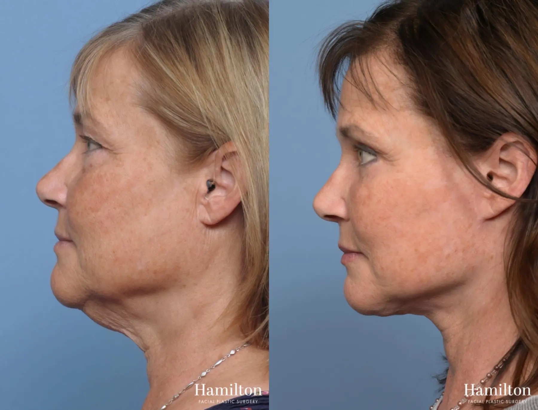 Facelift: Patient 3 - Before and After 4