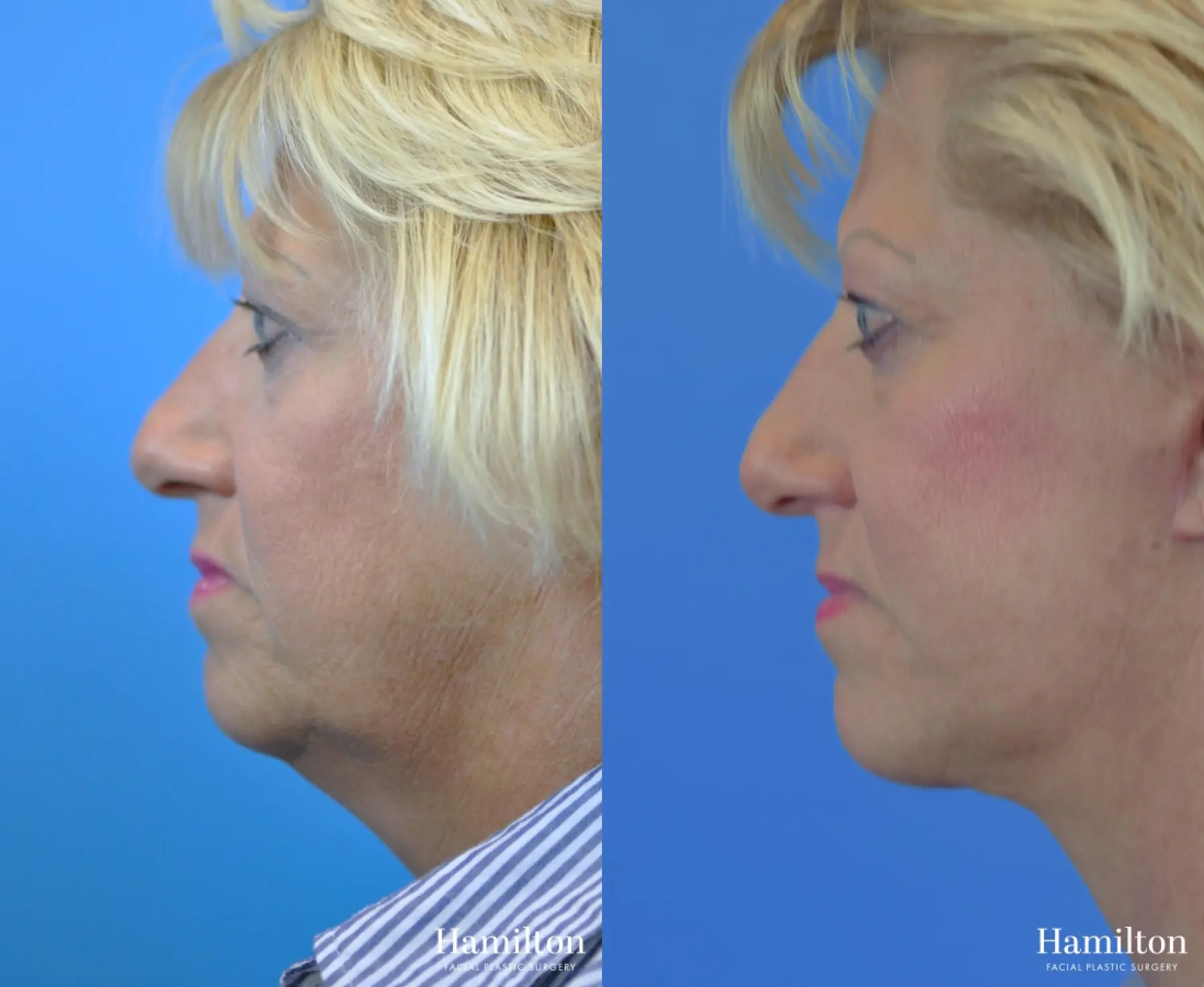 Facelift: Patient 31 - Before and After 2