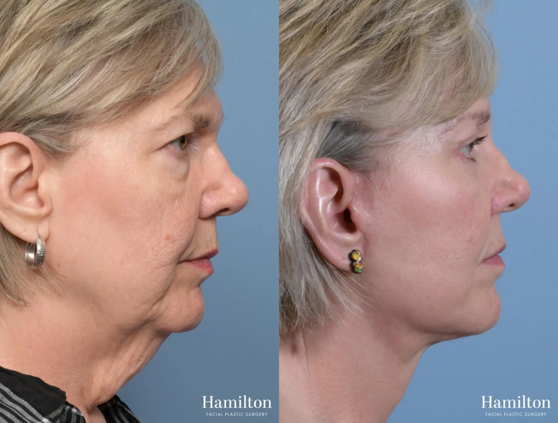 Facelift: Patient 1 - Before and After 2