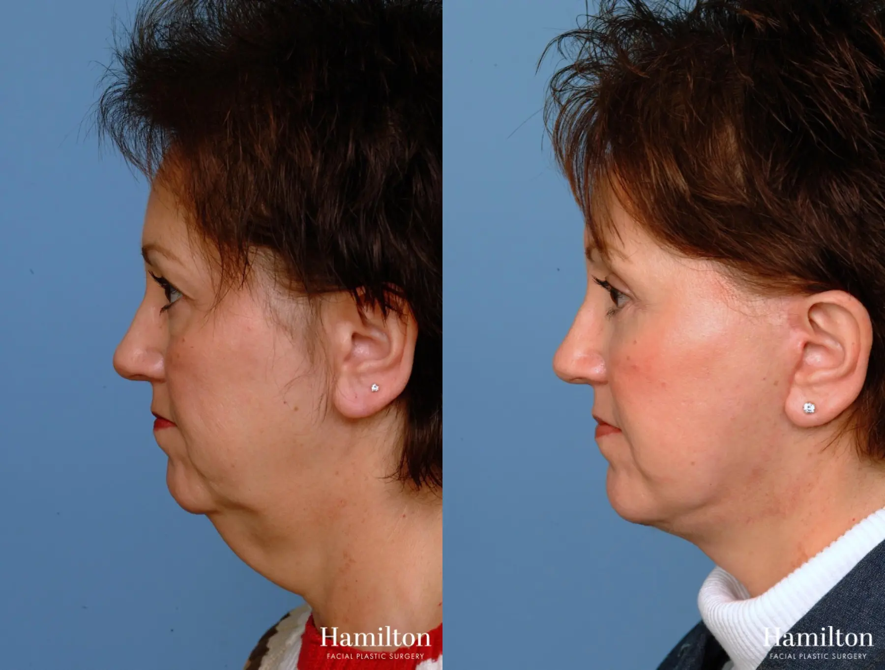 Facelift: Patient 18 - Before and After 1