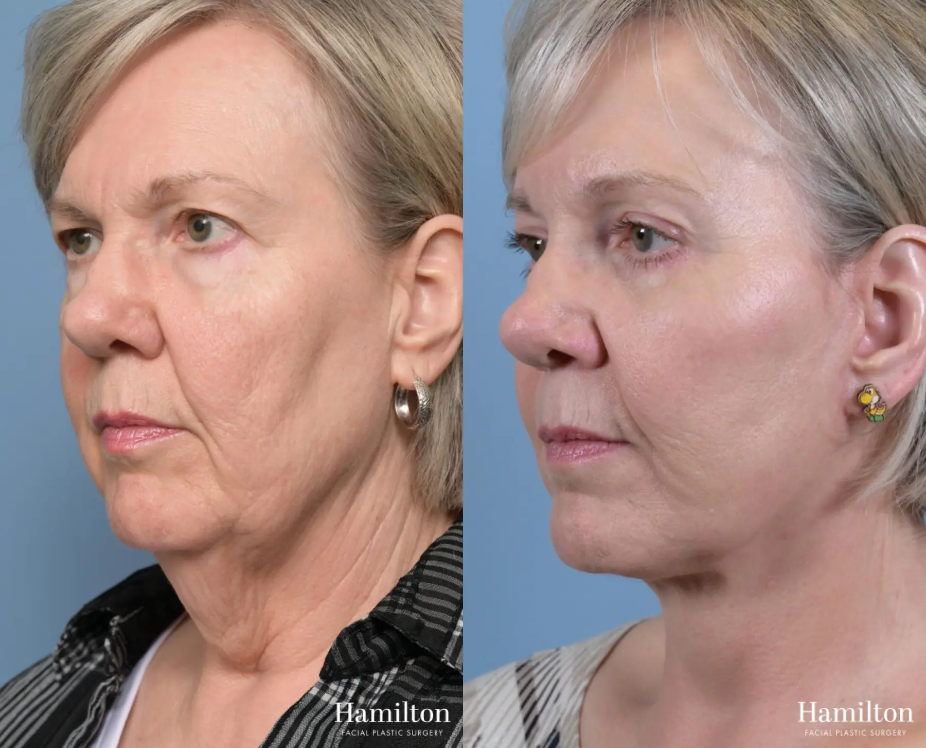 Facelift: Patient 1 - Before and After 4