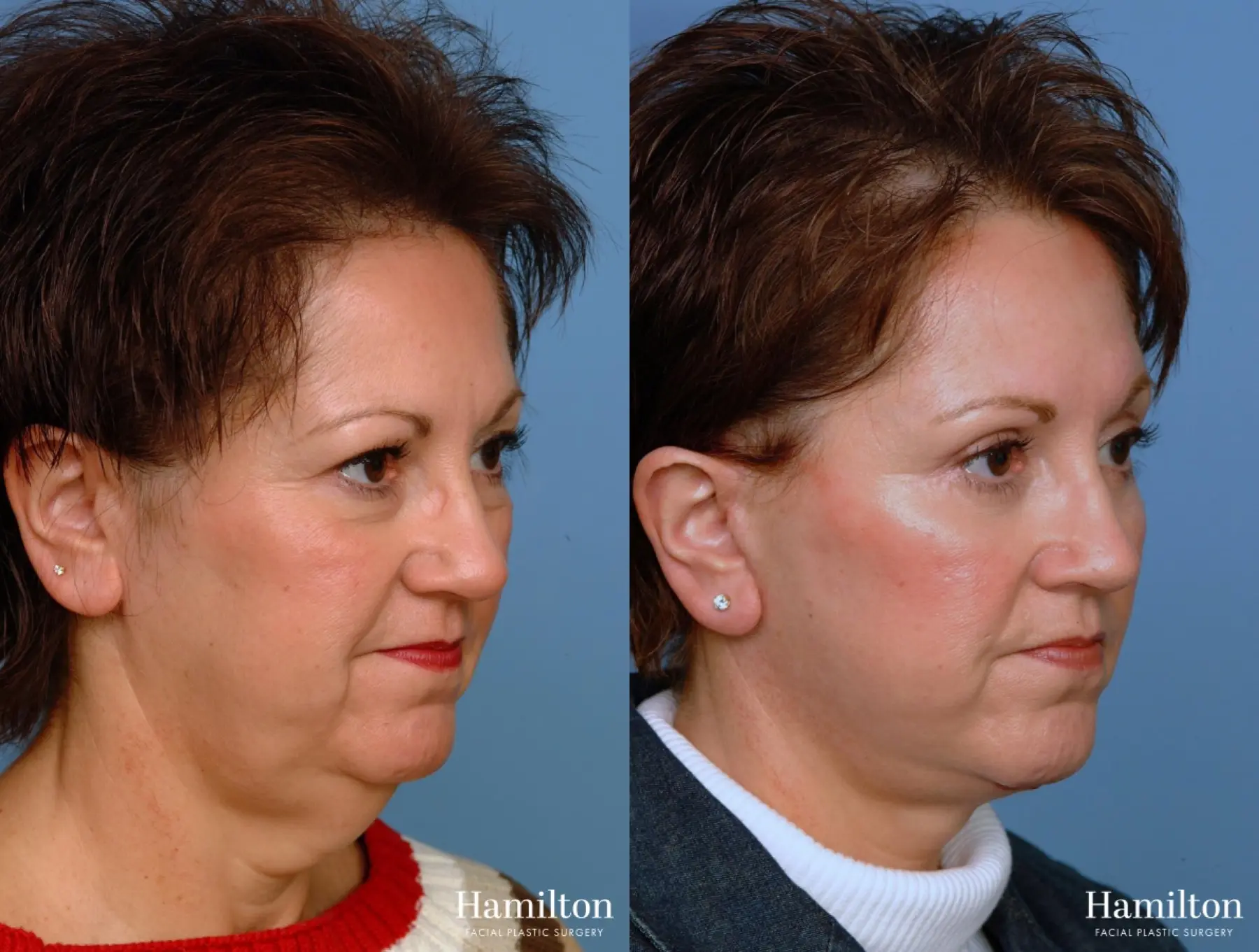 Facelift: Patient 18 - Before and After 2