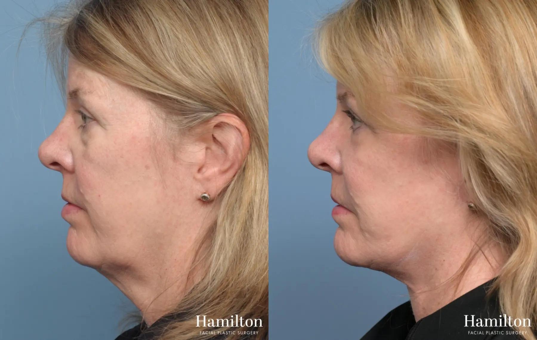 Facelift: Patient 40 - Before and After 5