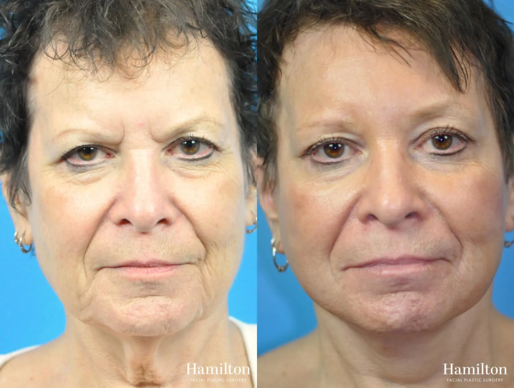 Facelift: Patient 39 - Before and After 4