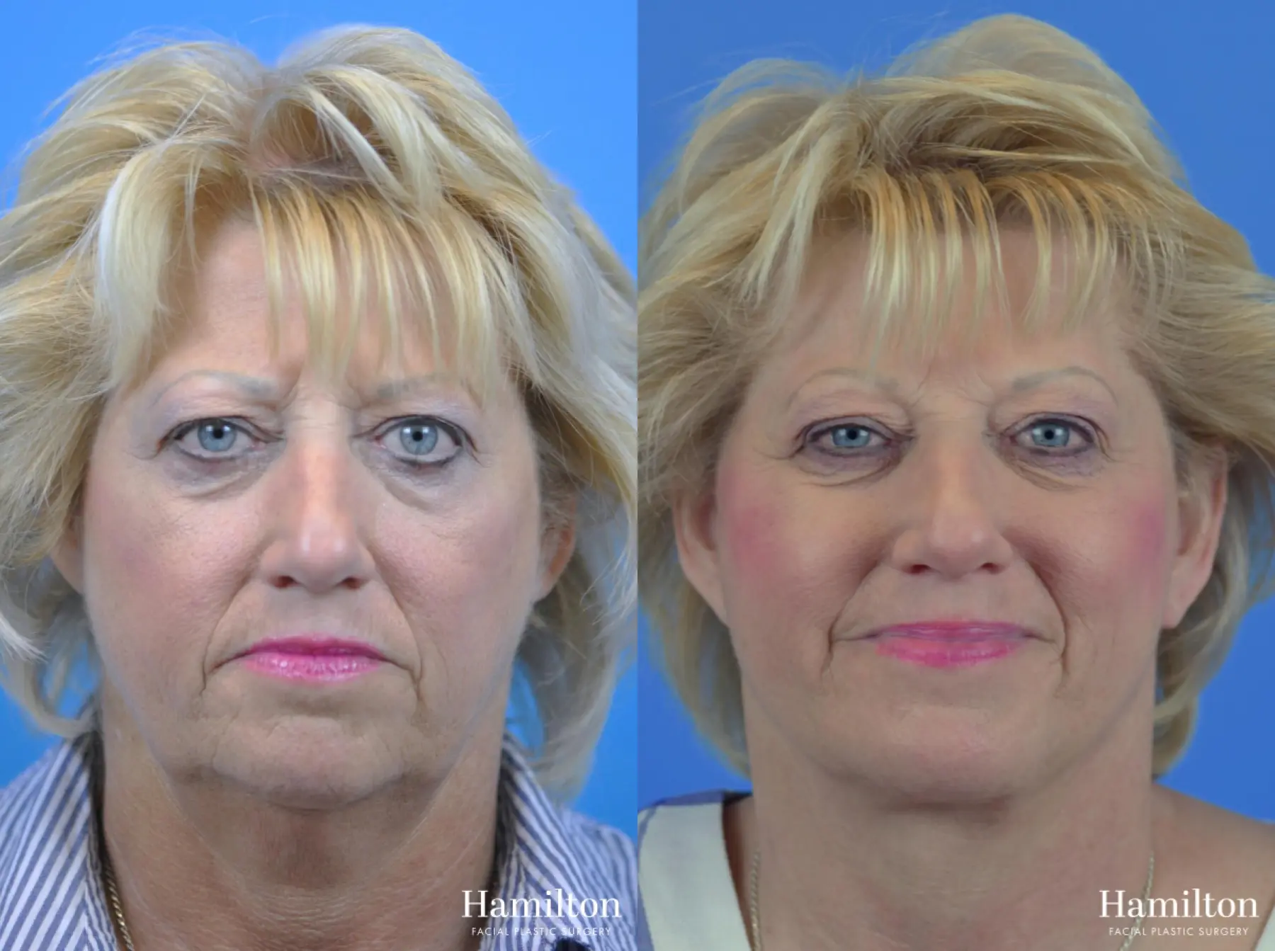 Facelift: Patient 31 - Before and After 3