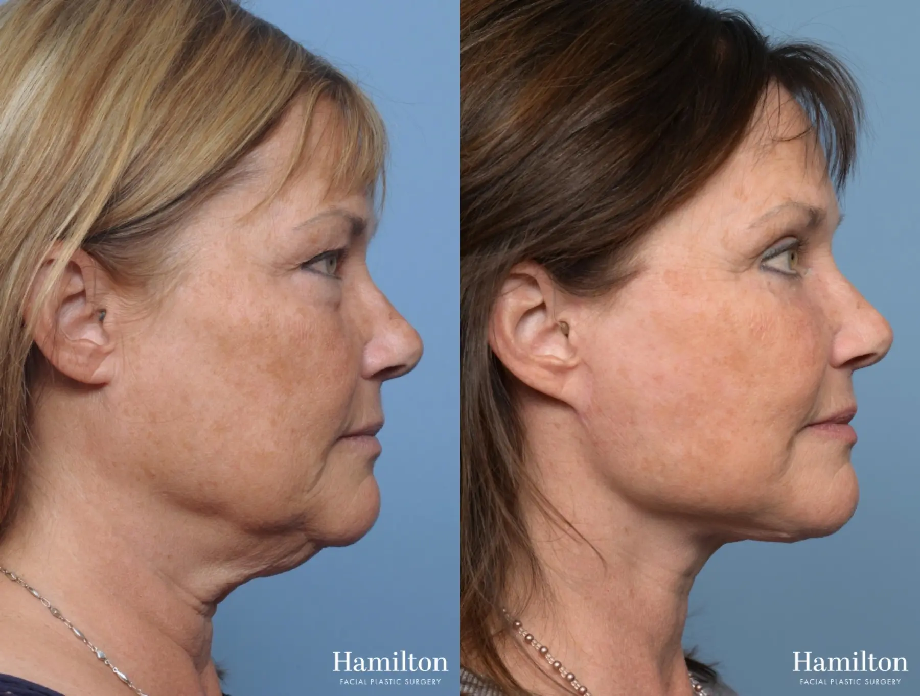 Facelift: Patient 3 - Before and After 3