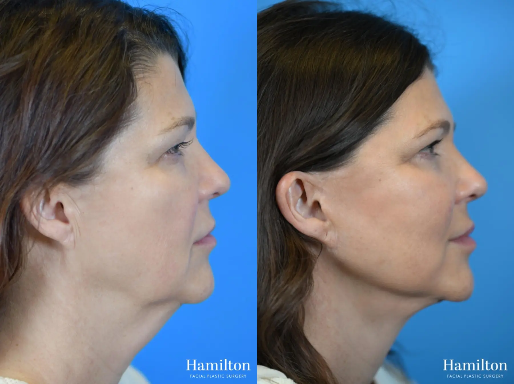 Facelift: Patient 10 - Before and After  