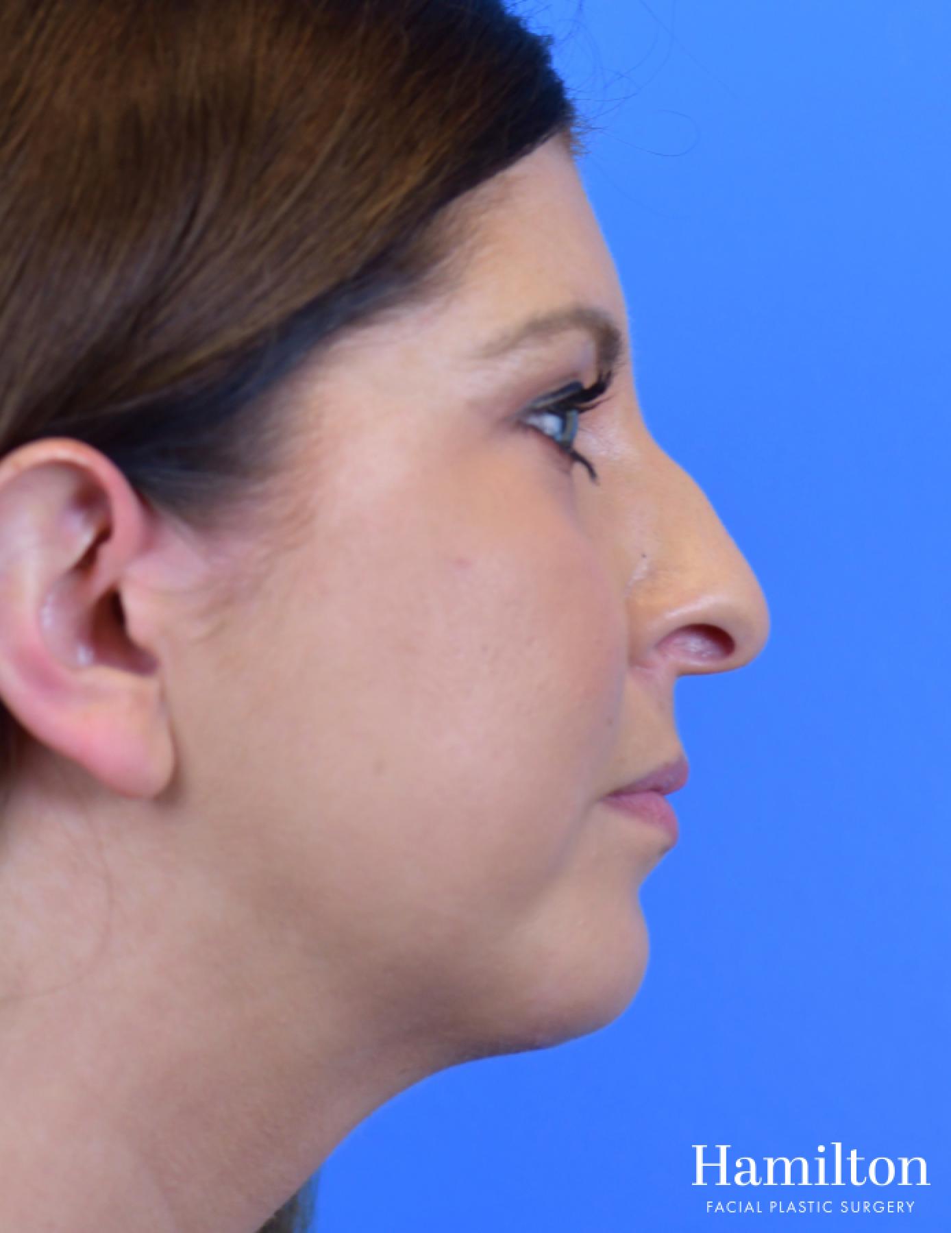 Chin Augmentation: Patient 9 - After 5