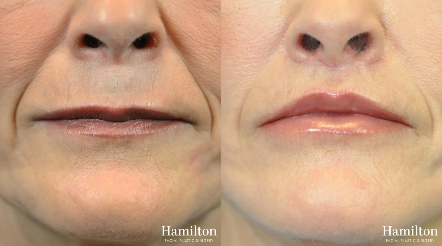 Lip Enhancement: Patient 3 - Before and After  