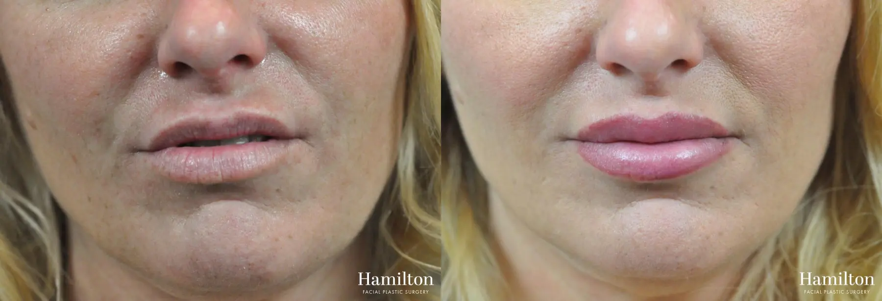 Lip Enhancement: Patient 4 - Before and After  