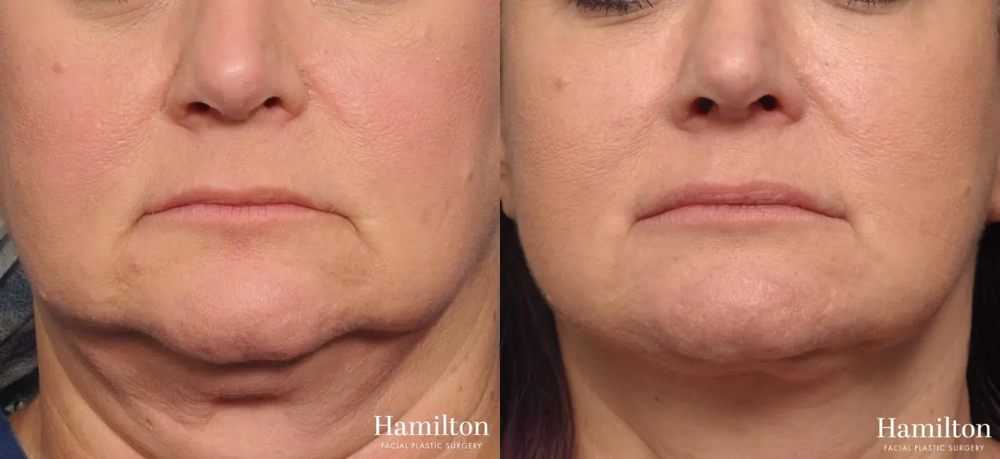 Lip Enhancement: Patient 5 - Before and After  