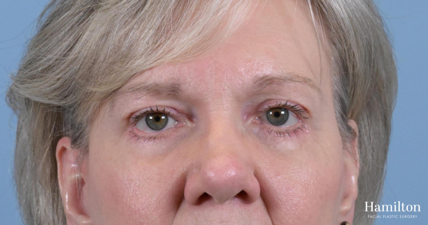 Blepharoplasty: Patient 18 - After 1